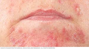 Image result for dermatitis contacta toxica