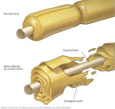 Why the disorder strikes some people is a mystery. Guillain Barre Syndrome Symptoms And Causes Mayo Clinic