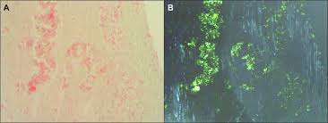 A histologic diagnosis of amyloidosis requires acquiring tissue containing amyloid fibrils from an affected organ or alternate site. Transthyretin Ttr Cardiac Amyloidosis Circulation