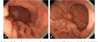 However, as stomach cancer grows and spreads, it exhibits some telltale signs and symptoms, even while still in the early stages. Pdf The Endoscopic Diagnosis Of Early Gastric Cancer Semantic Scholar