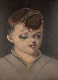 And, where did you get it anyway? Girl Showing The Effects Of Congenital Syphilis Europeana