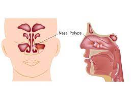 In this article, we shall look at the applied anatomy of the nasal cavity, and some of the relevant clinical syndromes. Nasal Polyp Treatment And Symptoms Houston Polyp Removal