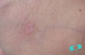 Image result for Primary Syphilis