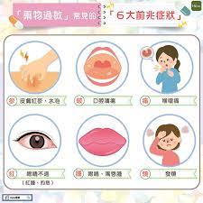 Mar 19, 2021 · 年輕人方面，如曾經有嚴重過敏反應者，不論其過敏類型，則應格外留神。 一般人打針前作身體檢查未必具效益，因只反映當刻情況。 有協助接種的家庭醫生則指，自今星期起，於打針前主動詢問身體狀況的市民增加約兩成，經診症後，已「勸退」約6名市民暫. è—¥ç‰©éŽæ•å¸¸è¦‹çš„ï¼–å¤§å‰å…†ç—‡ç‹€ Hehoå¥åº·