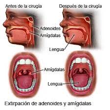 Amigdalectomia Care Guide Information En Espanol