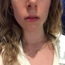 Jul 25, 2019 · typically, in most areas of the face, you'll experience slight swelling that will peak and subside within two weeks after treatment, at which point in time, you'll see the actual results from the filler injection. Exactly What To Expect From Lip Fillers Into The Gloss