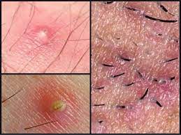 If you get a bacterial or staph infection (staphylococcus) in the cysts, it will result in the accumulation of yellowish to greenish pus, tender bumps that may turn red and feel warm. Best Ways To Get Rid Of Ingrown Hair