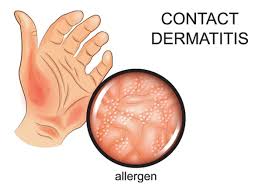 Image result for dermatitis contacta children