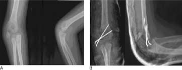 Documents similar to supracondylar fracture of humerus in children. Images And Treatment Of Humeral Lateral Condyle Fracture The Images Download Scientific Diagram