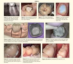 Panavia ™ sa cement plus is an ideal everyday cement for zirconia crowns and bridges. An Evaluation Of Two Luting Cements Dentistry Today
