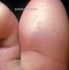 Image result for Pitting nails feet