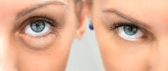 Red lipstick isn't just for making your lips beautiful and bright. How Filler Can Cure Your Dark Under Eye Circles Integrated Dermatology Of Reston