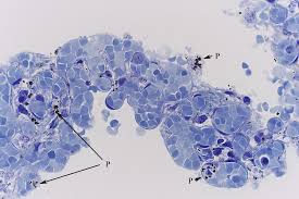 This paper aims to report a case of mesothelioma in a dog, obtained from the cytological analysis of pleural and abdominal fluid, which allowed an in vivo diagnosis. Die Stauungslunge Aus Den Blockchen Von Robin Wacker