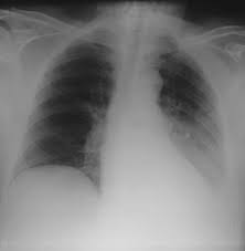 Specifically, fluid accumulates within the pleura—thin membranes that line the lungs and inside of the chest. Comparative Interpretation Of Ct And Standard Radiography Of The Pleura