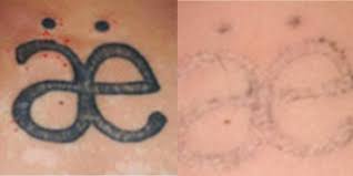These 6 factors will arm you. Laser Tattoo Removal Prices Results Benefits Risks Nexus Clinic Kuala Lumpur Malaysia