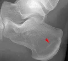 Image result for Calcaneus Compression Fracture