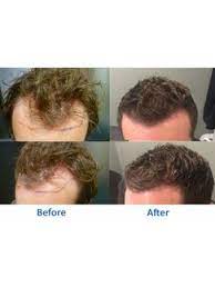 As for the prices of these two types of products, they are offered at over 300 us dollars in our store. Hair Transplant In Europe Check Prices Reviews