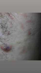The pain level of the lump isn't necessarily an indicator of severity related to terminal illness diagnosis. Lump Help Please Cancer Forums Patient