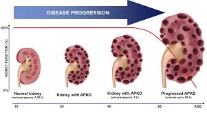 Besides medicine, he has a great passion for cooking food, video gaming and blogging. Study Shows Polycystic Kidney Disease Can Be Treated By Ketogenic Diet Thailand Medical News In 2021 Polycystic Kidney Disease Polycystic Kidneys Kidney Disease