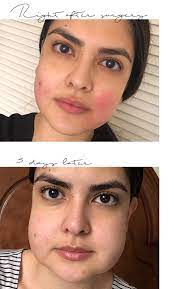 Bichectomy or also known as a type of aesthetic that is often referred to by hollywood stars. I Went Through Bichectomy And This Happened Noirette Diary