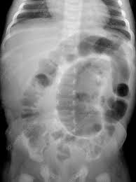 Hirschsprung S Disease X Ray Stock Image C023 4556 Science Photo Library