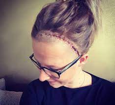 Ich Hatte 5 Jahre Ein Aneurysma Im Kopf Und War Eine Tickende Zeitbombe Echte Mamas