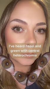 Hazel Eye Vs Central Heterochromia
