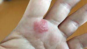 Image result for Contact Dermatitis