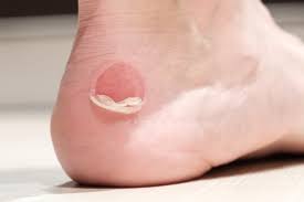 Follow your doctor's orders to prevent infection, know what an infected burn looks like, monitor your burn wound so you know if it is infected, and report any signs of infection to your doctor immediately. Blisters Mydr Com Au