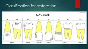 Classification For Restoration By Black Dental Art
