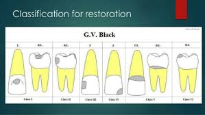 classification for restoration by black dental art