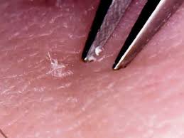 Ingrown hairs on penis are usually associated with hair removal because they tend to appear after shaving. Plucking Multiple Hairs Ingrown Hair Youtube