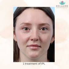 Bye, bye freckles and sun damaged skin👋 , Our patient was recommended 3  treatments of IPL laser. Check out her results after just one treatment!!  She is very happy 🤭, p.s. friendly reminder to wear ...