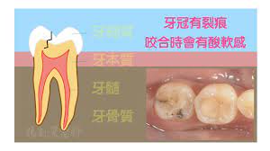 牙齒有酸酸的感覺，牙齒是怎麼了呢？ PART III：牙冠裂了- 牙科美容資訊- 美容牙科張凱榮醫師