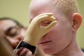 New limbs, new hope for Africa's hunted albino children