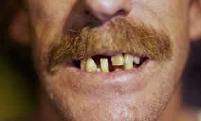 Lindsay lohan shocked fans when she debuted a new look in 2011. The Difference Between Rich And Poor Eight Teeth Says Dental Study