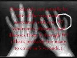 Having a crroked pinky means you, most likely need medical treatment. The Only Youtube Video On Clinodactyly Youtube