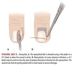 Image result for paronychium