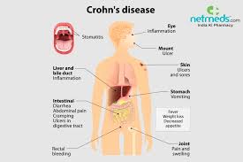 Watch a video to get the facts about who gets crohn's. Crohn S Disease Causes Symptoms And Treatment