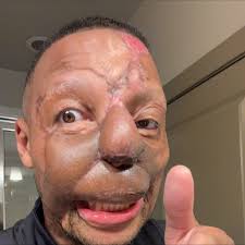 Fireman Bradley Richards (24 years old) who sustained 70% burns has passed  away. RIP. Knysna now claims 5th life