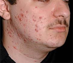 Treatment of severe recalcitrant nodular acne in patients who are unresponsive to conventional therapy, including systemic antibiotics. Disorders Of Sebaceous And Apocrine Glands Fitzpatrick S Color Atlas And Synopsis Of Clinical Dermatology Seventh Edition