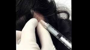 Image result for hair loss alopecia areata treatment