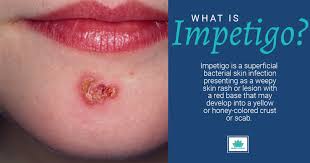 Image result for Impetigo