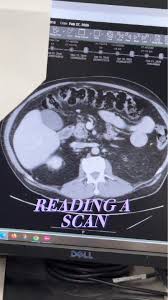 Image result for CT Intravenous Contrast