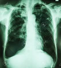 All 28 control roentgenograms were scored correctly. Pneumothorax In Rontgen Thorax Zu Sehen Die Drainage Zu Intercostral Wollen Lizenzfreie Fotos Bilder Und Stock Fotografie Image 53186118