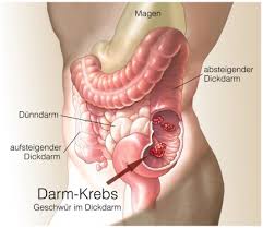 Dies weist darauf hin, dass irgendwo im verdauungstrakt blutungen auftreten. Dickdarmkrebs Kolonkarzinom Ursachen Beschwerden Therapie Gesundpedia De