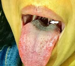 Image result for Uvulitis