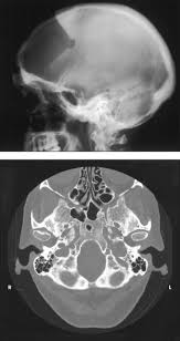 Image result for Skull XRay