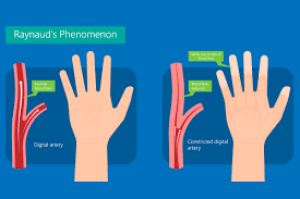 Image result for Paresthesia