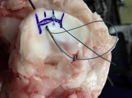 Outside-In Continuous Suturing Is Superior to Interrupted Suturing for  Repairing Peripheral Meniscus Lesions: An In&nbsp;Vit